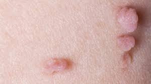 Fibroid adalah satu kondisi penyakit yang mungkin sudah pernah anda dengar atau ketahui, namun sebenarnya penyakit ini masih terbilang kurang familiar di telinga kita. 5 Cara Mudah Alami Menghilangkan Daging Tumbuh Di Kulit Banjarmasin Post