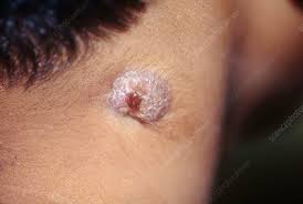 Authoritative facts from dermnet new zealand. Tuberculosis Colliquativa Cutis Keyword Search Science Photo Library