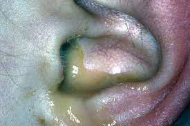 Ear Infections And Trauma Gponline