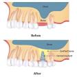 Bone Grafting & Sinus Lift product image