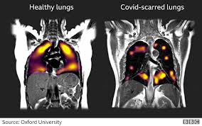 University of oxford terms for oxford university students, the year is divided into three terms of eight weeks each. Covid 19 Lung Damage Identified In Study Bbc News