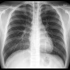 Normal Frontal Chest X Ray Radiology Case Radiopaedia Org In 2020 Radiology X Ray Radiology Student