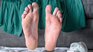 It is suggested that the bacteria type is actinomyces. This Cult Favorite Foot Peel Made My Feet Look Disgusting Was It Worth It Reviewed