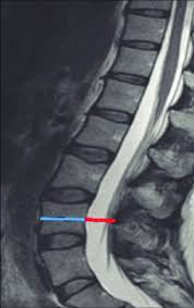 Image result for Low Back Imaging