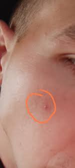 Красная точка Года 3 назад на лице появилась красная точка , бывает она |  MedAboutMe