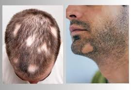 Image result for Alopecia