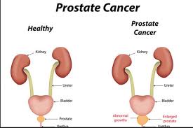 Of course, your specialist is the main person whose advice you should follow but it doesn't do anyone harm. Prostate Cancer In Jaipur Id 18750735948