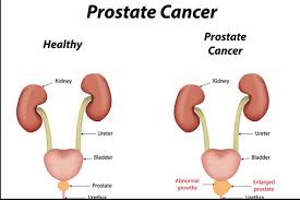 Incontinence after radical prostatectomy sucks. Prostate Cancer In Jaipur Id 18750735948
