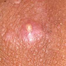 Before developing into a typical cyst, an infected ingrown hair normally begins as a small or big pimple. Boil Muddy Creek Pediatrics