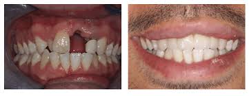 We did not find results for: Dental Implants In 1 Day In Kingston Don T Settle For Dentures Gentle Dental Implant And Cosmetic Centre
