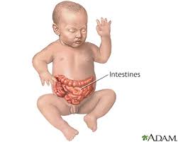 Image result for Necrotizing Enterocolitis