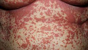 Pityriasis rubra pilaris (prp) is a rare inflammatory papulosquamous skin disease that is often refractory to conventional therapies. Pityriasis Rubra Pilaris Oder Psoriasis Schwierige Differenzialdiagnose