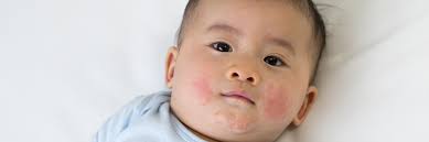Image result for sweat rash on back baby