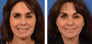 Bell's palsy before and after. Bell S Palsy Conditions Treatments Facial Paralysis Institute