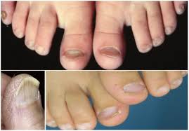 Image result for Koilonychia feet