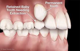 Or children pull them with their fingers or tongue. Tooth Extractions Family And Children S Dentistry Atlanta Georgia
