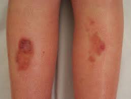 The face, legs, eyelid skin are common areas for petechia spots. Rashes Affecting The Lower Legs Dermnet Nz