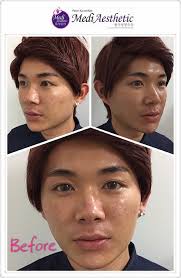 Prp registration with malaysia pharmacy board via prisma. Sports Injury Treatment Johor Bahru Prp Platelet Rich Plasma Treatmentbest Medical Aesthetic Clinic In Johor Bahru