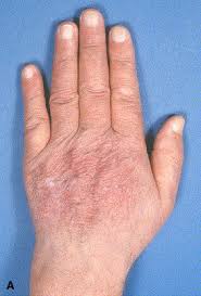 「"新しいコメントをメールで通知" depigmentation」の画像検索結果