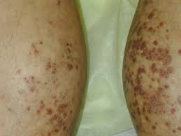 Spontaneous bleeding into the skin usually appears as a rash known as purpura (figure 1). Red Rashes On The Lower Legs Page 3 Of 3 Clinical Advisor