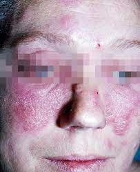 Jeg får sånne røde mygg liggnende bitt på ansiktet vanligvis etter berøring. Lupus Felleskatalogen