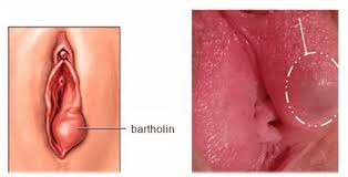 Image result for Bartholin's gland abscess