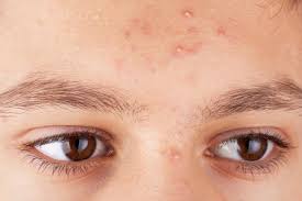 Hier matin, je suis allée lever nicolas, et qu'elle ne fut pas ma bonjour, ma fille de 21 mois pressente les mêmes symptômes ! Acne Boutons Points Noirs Imperfections Jusqu A Quel Age