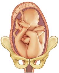 Image result for Breech Presentation