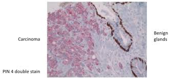 However, as with other types of cancer,. Hrm Prostate Cancer Pathology Dr Mcgary 1 Hr Flashcards Quizlet