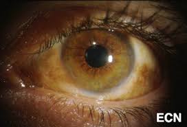 Image result for conjunctival melanoma
