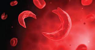 The defect that causes thalassemia (or other conditions such as hemoglobin c or e) can also be inherited along with the defect that causes sickle cell disease. Sickle Cell Trait Vs Sickle Cell Disease Get Healthy Stay Healthy