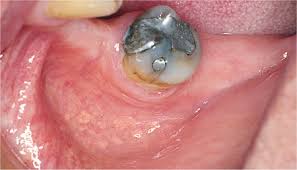 Maybe you would like to learn more about one of these? 5 White Patches Pocket Dentistry