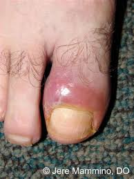 See full list on mayoclinic.org Paronychia Nail Infection American Osteopathic College Of Dermatology Aocd