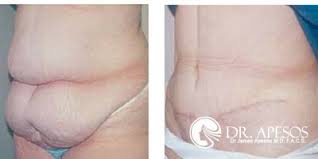 The Average Cost Of A Breast Augmentation Tummy Tuck