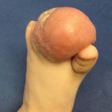 Softening of your nail beds, which makes your nails seem like they're floating enlarging or bulging of the tip of your fingers or toes, which may be accompanied by redness or warmth these changes. Firm Tumor Encasing The Left Second Toe Of An Infant Mdedge Dermatology