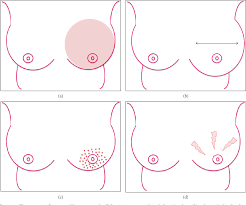 Many women don't feel a lump. Pdf Challenging A Misnomer The Role Of Inflammatory Pathways In Inflammatory Breast Cancer Semantic Scholar