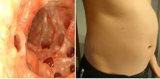 Colon cancer is sometimes called colorectal cancer, which is a term that combines colon cancer and rectal cancer, which begins in the rectum. 50 Des Cas De Cancer Du Colon Peuvent Etre Evites En Faisant Ceci