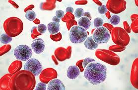 Image result for Acute Leukemia