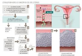 Cancers du col de l'utérus: Cancer Du Col De L Uterus Les Armes Sont La