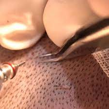 Thebarberpost Presents To You Hairofistanbul With Transplante Video Clip Trendi Beauty Standards Hair Transformation Mens Hairstyles