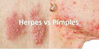 Pin On Herpes Cure