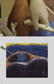 Image result for Tendon Sheath Injection