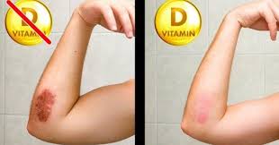 D Vitamini Vucudunuzdaki Cesitli Sistemler Uzerinde Guclu Etkileri Olan Son Derece Onemli Bir Vitamindir Diger Vita Vitamins Vitamin D Immune System Vitamins