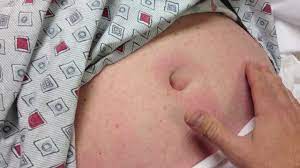 Closeup umbilical hernia in a pregnant woman. Umbilical Hernia With Fat Herniation Youtube