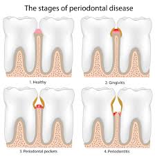 Oral Health And Gum Disease Kids Dental Online Plano Carrollton