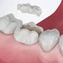 Resin inlay dental from www.mpdg.com