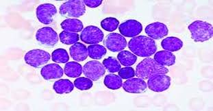 The most widely used antileukemic treatment is chemotherapy, that is, the use of powerful drugs to kill leukemia cells. Acute Lymphocytic Leukemia Causes Symptoms And Treatment Assignment Point