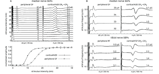 Stimulus Intensity And Frequency Cf And Pf Cubital And Popliteal Download Scientific Diagram