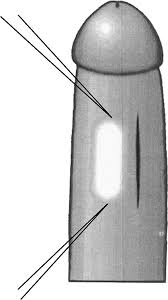 It feels like a ridge or a row of tiny bumps. Surgical Treatment Of Peyronie S Disease By The Intracavernosal Plaque Excision Method A New Surgical Technique European Urology