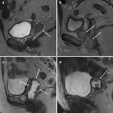Uterine cancer is a common disease in women over 50 years old. Vaginal Recurrence Of Endometrial Cancer Mri Characteristics And Correlation With Patient Outcome After Salvage Radiation Therapy Springerlink